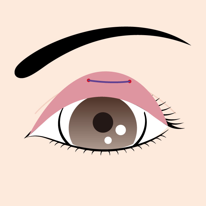 切らない眼瞼下垂